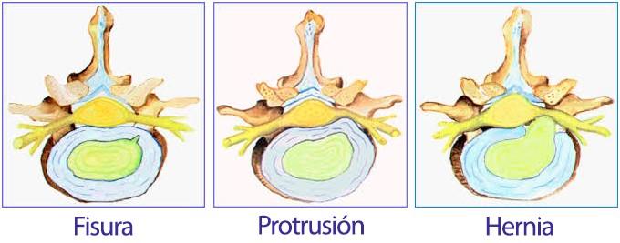 Hernia Discal-Pamplona